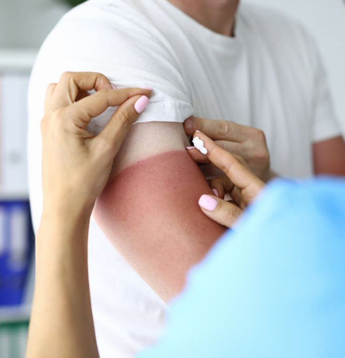 Nurse help with skin burn
